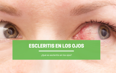 ¿Qué es escleritis en los ojos?