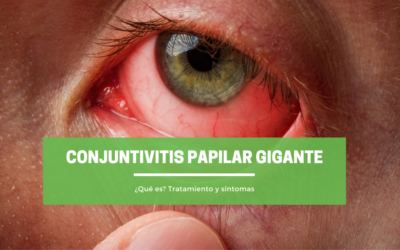 Conjuntivitis papilar gigante: ¿Qué es? Tratamiento y síntomas