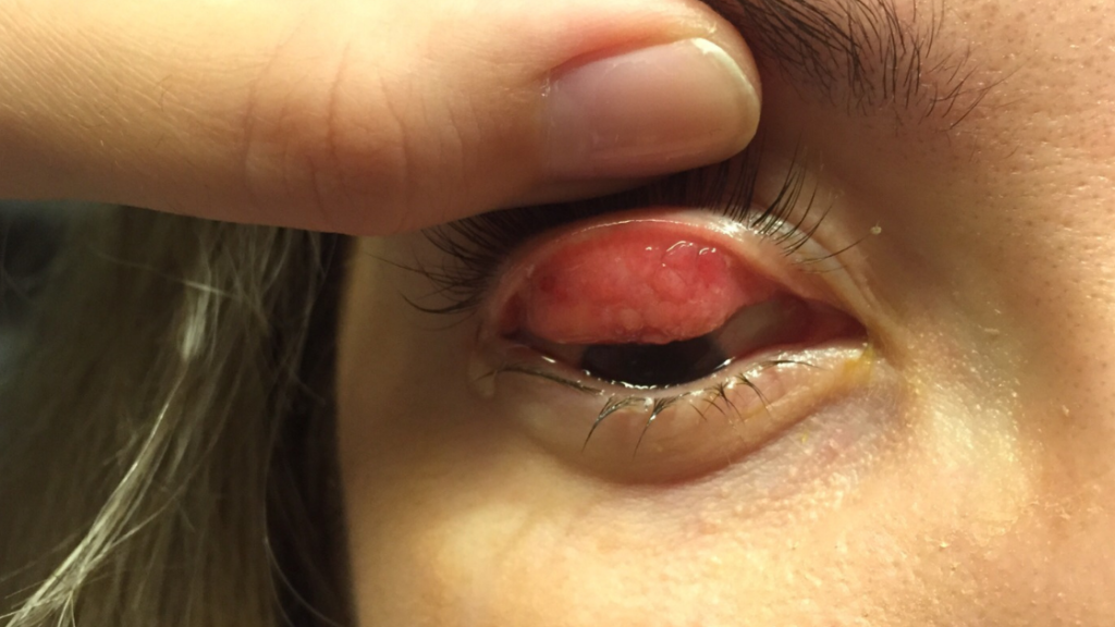 ejemplo de un paciente de conjuntivitis papilar gigante y su tratamiento