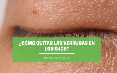 ¿Cómo quitar las verrugas en los ojos?