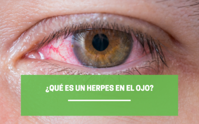 ¿Qué es un herpes en el ojo?