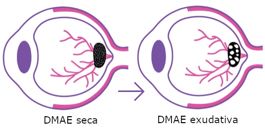 dmae seca y dmae humeda